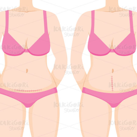 C Section Cesarean Operation Clipart Vector Illustration 05195