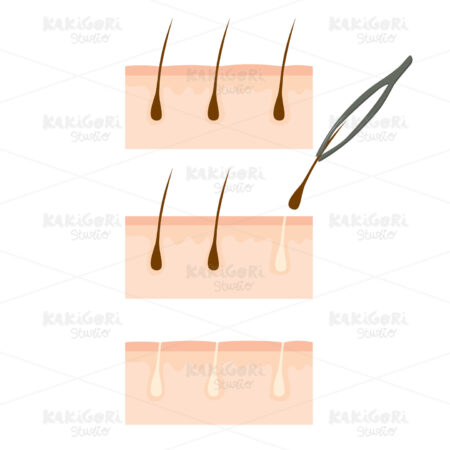 Follicle Hair Removal Clipart Vector Illustration 02718