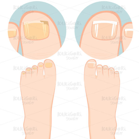 Nail Fungal Infection Clipart Vector Illustration 03047