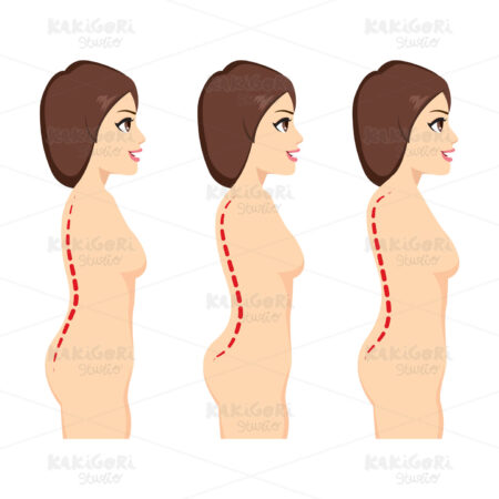 Scoliosis Medical Condition Clipart Vector Illustration 03914