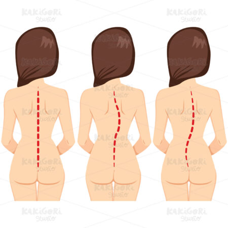 Woman Scoliosis Clipart Vector Illustration 03913